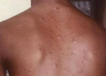 Kyandar-Biri Ta Bulla A Jihar Borno