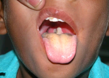 Diphtheria: Mutane 123 Sun Kamu, 38 Sun Mutu A Jihohi 4 – NCDC