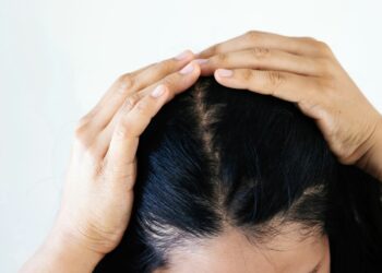 Hanyoyin Magance Amosanin (Dandruff)