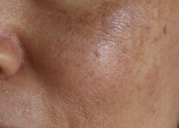 Amfanin Danyen Kwai Wajen Magance Kurajen Fuska