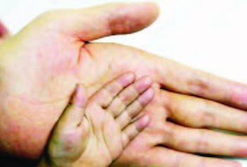 Magance Bushewar Tafin Hannu A Lokacin Bazara