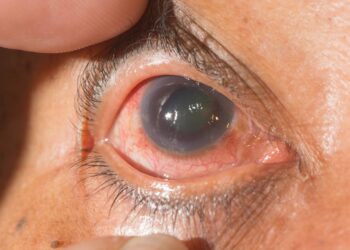 Yadda Ciwon ‘Glacoma’ Ke Haddasa Makanta