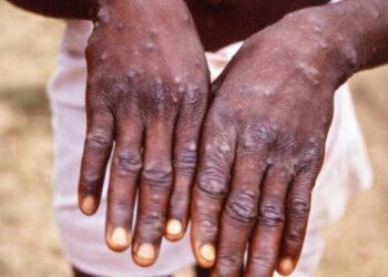 An Fara Amfani Da Kimiyya Da Fasaha Wajen Yaki Da Cutar Kyandar Biri