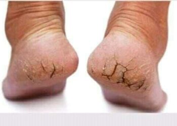 Hanyoyin Magance Kaushin Fata Lokacin Sanyi