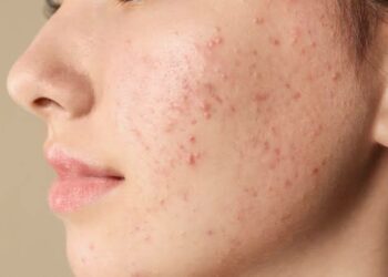 Tattaunawa Kan Ƙurajen Fuska (Pimples)