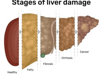 Nau’in Abinci Biyar Da Ke Lalata Hanta