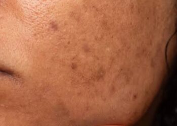 Maganin Kurajen Fuska