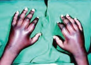 Yara 150,000 Ake Haifa Da Cutar Sikila A Nijeriya Duk Shekara – Rahoto