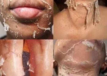 Yadda Man Bilicin Ke Yi Wa Fatar Mutum Illa