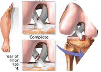 Me Ya Sa Ciwon ACL Ya Zama Barazana Ga ‘Yan Wasan Kwallo?