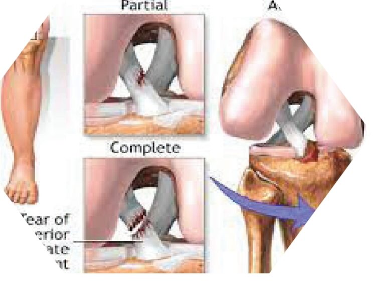 ACL ACL