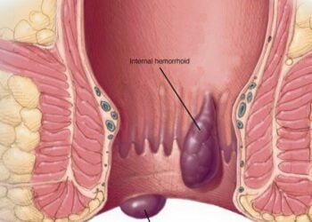 Hanyoyin Kare Kai Daga Cutar Basir Cikin Sauƙi