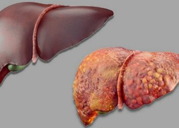 Saliyo Yadda Ciwon Hanta Ke Yaɗuwa Tsakanin Ma’aurauta