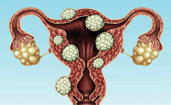 Illar Kari (Fibroid) Da Kuma Maganinsa