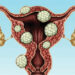 Illar Kari (Fibroid) Da Kuma Maganinsa