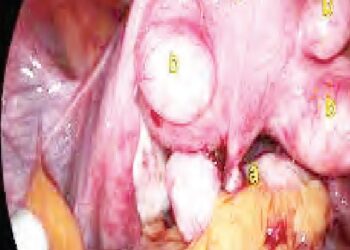 Dalilan Da Suke Sa Mata Samun Ƙarin Mahaifa (Fibroid) (2)
