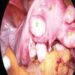 Dalilan Da Suke Sa Mata Samun Ƙarin Mahaifa (Fibroid) (2)